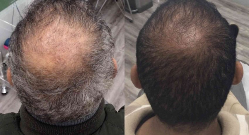 Hair Transplant Turkey